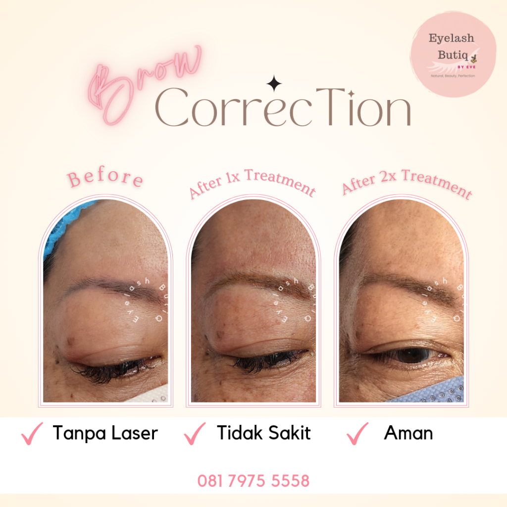 Brow Correction Bandung sebelum sesudah
